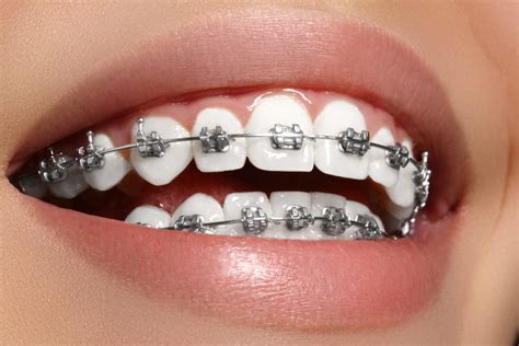 The Dos And Donts Of Braces Care Moles And Ferri Orthodontic Specialists