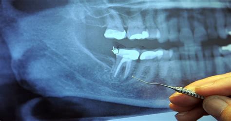 Check spelling or type a new query. This dentist refused to perform any root canal for over 20 ...
