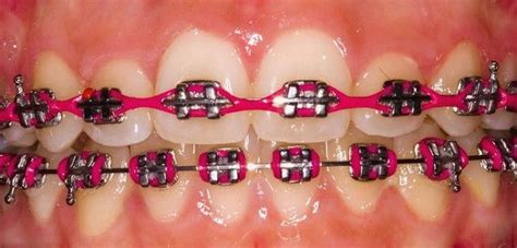 Power Chain Braces Colors Im Supposed To Be Getting Elastics And A Powerchain For