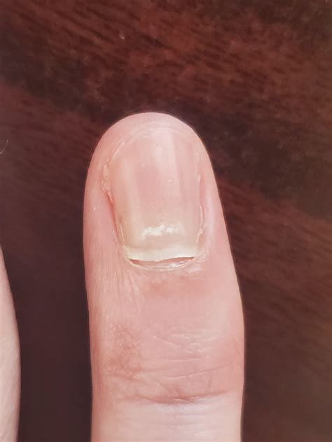 Is My Fingernail Going To Fall Off Medical