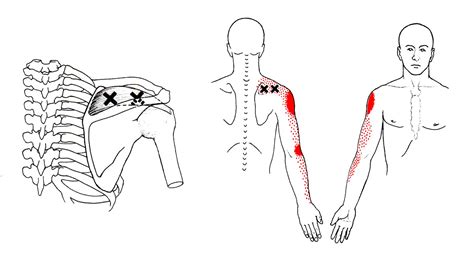 Supraspinatus The Trigger Point And Referred Pain Guide