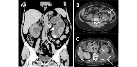 Ct Staging Of Xanthogranulomatous Pyelonephritis A A 76 Year Old