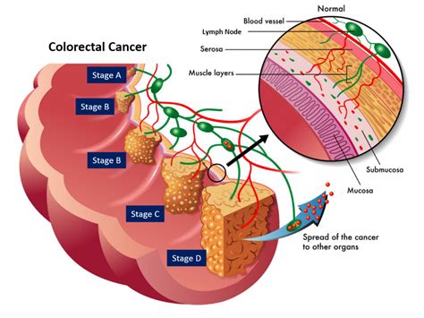 Colorectal Cancer Stages