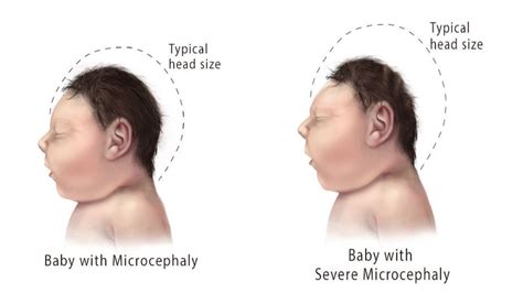 Microcephaly Pictures
