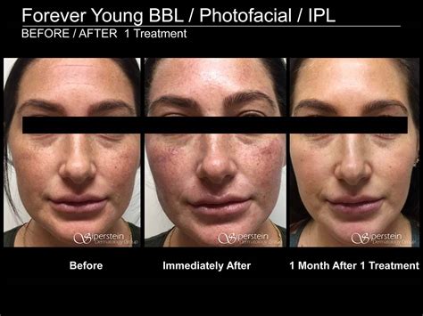 Forever Young Bbl Ipl Photofacial Siperstein Dermatology Group