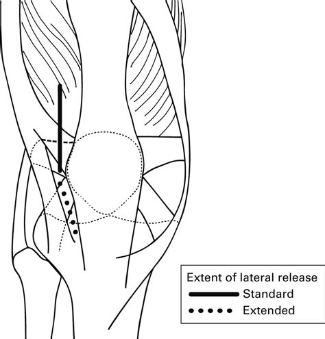 What Is The Role Of Lateral Retinacular Release Bone And Joint