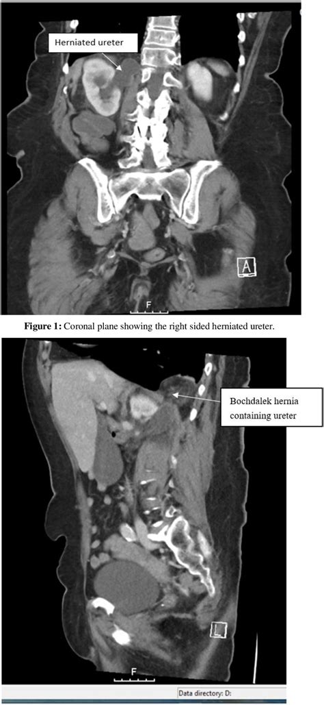 Figure 1 From Right Sided Bochdalek Hernia With Ureteric Involvement