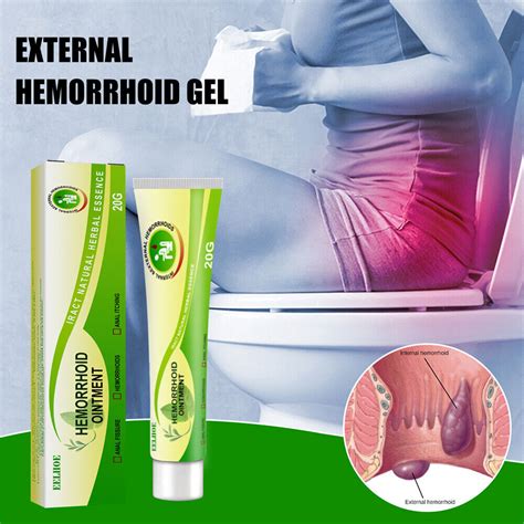 hemorrhoids ointment herbal materials powerful hemorrhoids cream external hemorrhoids anal