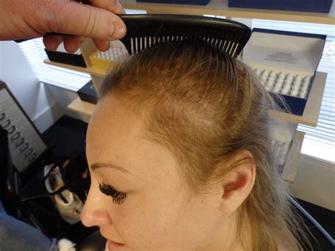The Hair Loss Centre Hair Loss In Women