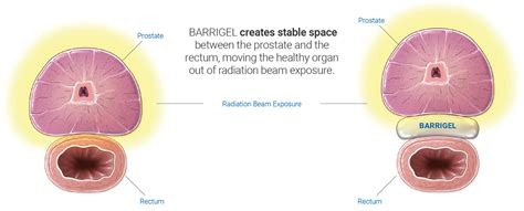 Radiation Therapy In Prostate Cancer Techniques And ‘spacers