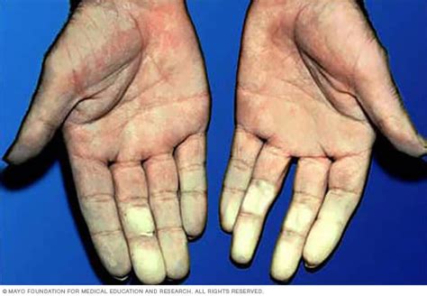 Raynauds Disease Symptoms And Causes Mayo Clinic
