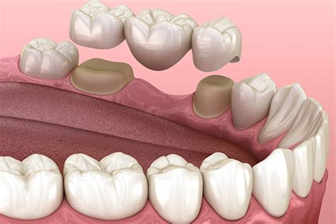 Options For Replacing Missing Teeth An Overview Of Dental Bridges