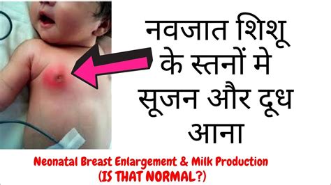 Neonatal Breast Enlargement Milk Production नवजत शश क सतन म सजन और दध आन YouTube