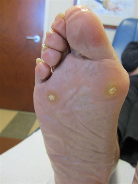 Bone Spurs Heel Pain Metairie Louisiana Foot Doctor