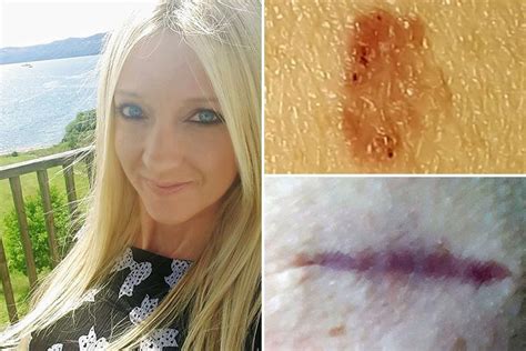 Sunbed Addict Lucky To Be Alive After Mole Tracking App Spotted Signs