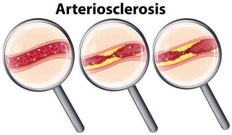 Symptoms Of Arteriosclerosis Diabetes And Coronary Artery Disease