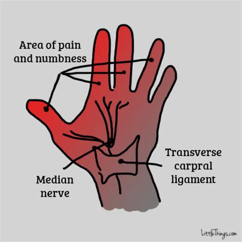 Here are four carpal tunnel syndrome exercises to help alleviate the symptoms of this condition. 9 exercises you can do to help prevent carpal tunnel ...