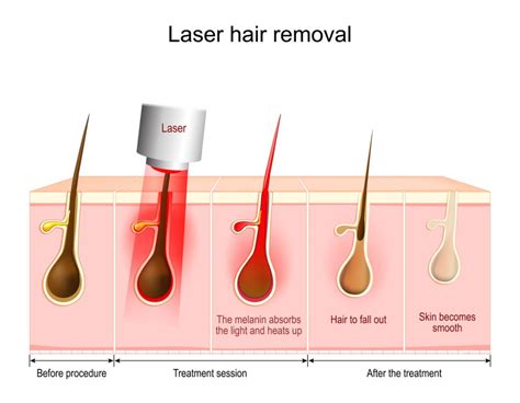 Laser Hair Removal Alaxis Medical And Aesthetic Surgery