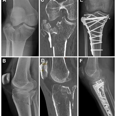 A Simple Split Aoota 41 B1 Tibial Plateau Fracture And Its Surgical