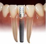 Dental Insurance Implants Pictures