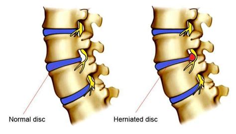 Treat Your Herniated Cervical And Lumbar Discs With Chiropractic Therapy Stamford Spine