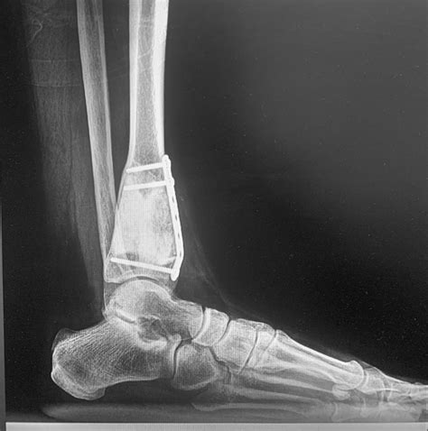 Bone Tumor The Foot And Ankle Online Journal
