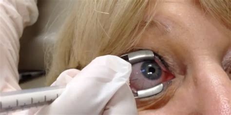 Intravitreal Injection Procedure American Academy Of Ophthalmology