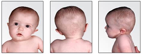 Torticollisplagiocephaly Pediatric Therapy And Learning Center