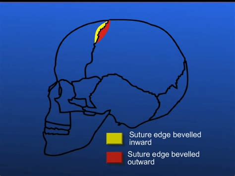 At The Coronal Suture The Frontal Bone Overlaps The Parietal Bone In