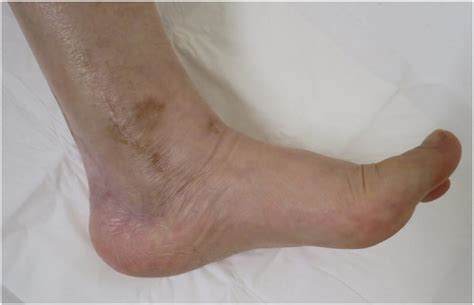 Photograph 2 Years After Surgery No Swelling Is Seen Over The Ankle