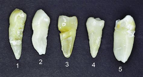 Clinical Picture Of Extracted Premolars With Noncarious Cervical