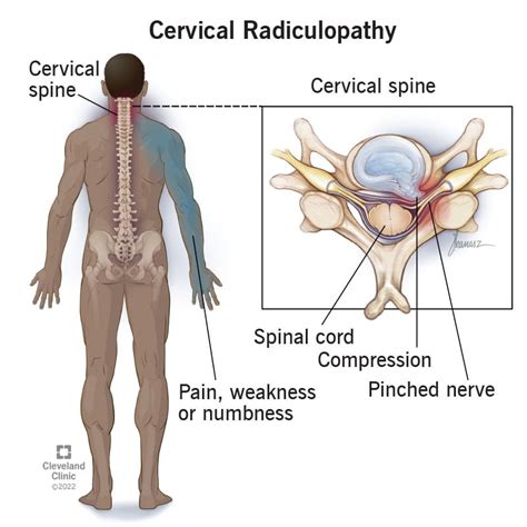 Cervical Radiculopathy Exercises Pdf Nhs Lawrence Bourgeois The Best Porn Website