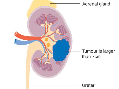 Kidney Cancer Renal Carcinoma L Symptoms Diagnosis And Treatments