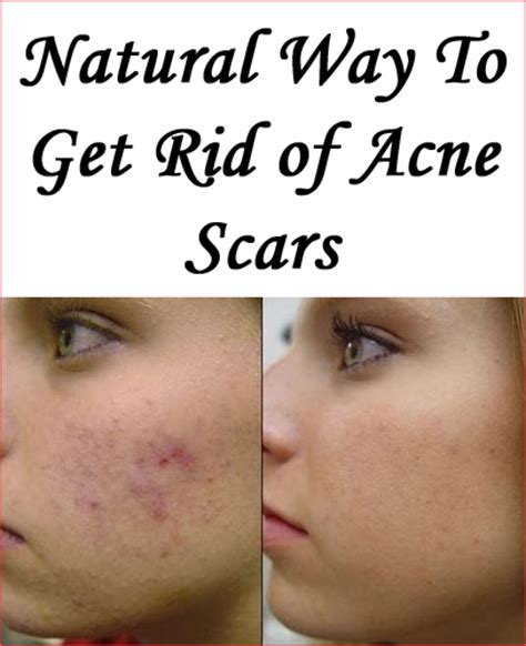 How To Get Rid Of Acne Scars Naturally Best Acne Scar