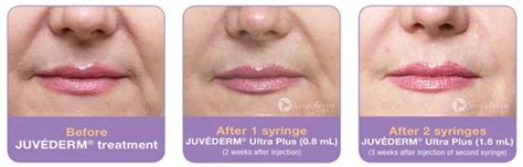 Juvéderm™ And Fillers Houston Medical Wellness Clinic
