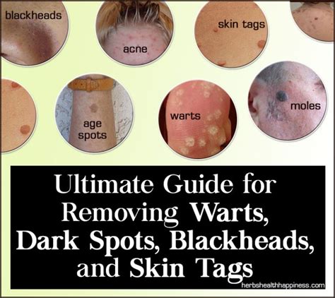 The Ultimate Guide To Naturally Removing Warts Dark Spots Blackheads