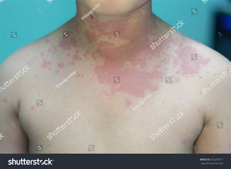 Erupción Alérgica Y Problema De Salud Foto De Stock 633267017 Shutterstock