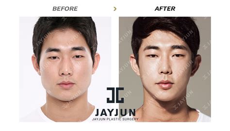 Korean Plastic Surgery Before And After Male Korean Styles