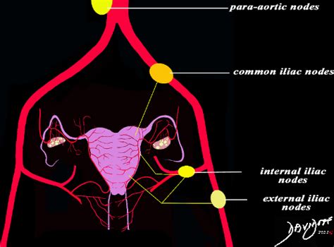 Lymphatic Drainage And Lymph Nodes Of The Uterus And Ovaries Art In