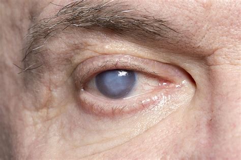 Cataract Symptoms Monterey Ca Monterey County Eye Associates