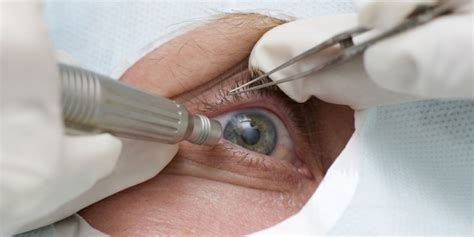 What To Expect After Cataract Surgery Mega Bored