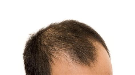 Genetics Strike Early Understanding Early Onset Hair Loss In Men