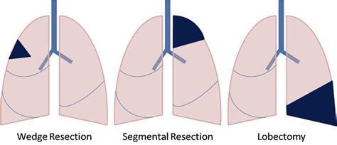 Lung Cancer Surgery Surgical Resection For Lung Cancer Patients