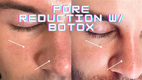 Pore Reduction Wbotox No More Greasy Skin Youtube