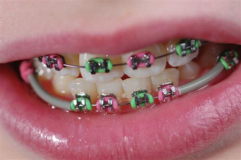 Turning Your Braces Into A Fashion Statement Dunn Orthodontics