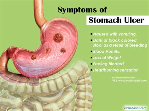 8 Foods You Should Avoid If You Have Stomach Ulcer Thescript Nigeria