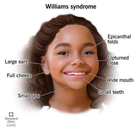 Williams Syndrome Williams Beuren Syndrome Causes Symptoms And Treatment