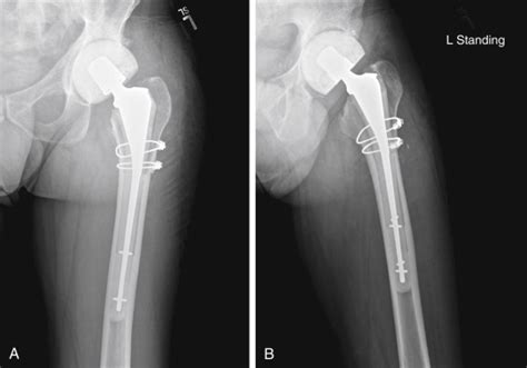Extended Trochanteric Osteotomy For Femoral Revision Musculoskeletal Key