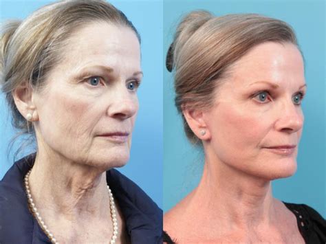 Facelift Before And After Pictures Case 19 West Des Moines And Ames Ia