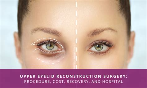 Everything You Must Know About Upper Eyelid Reconstruction Surgery